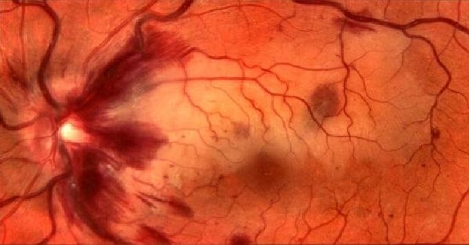 blood vessels of the retina and vision restoration